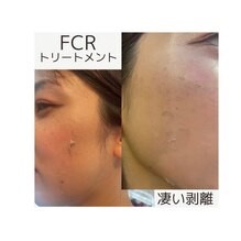 fcrハーブピーリング 医療機関